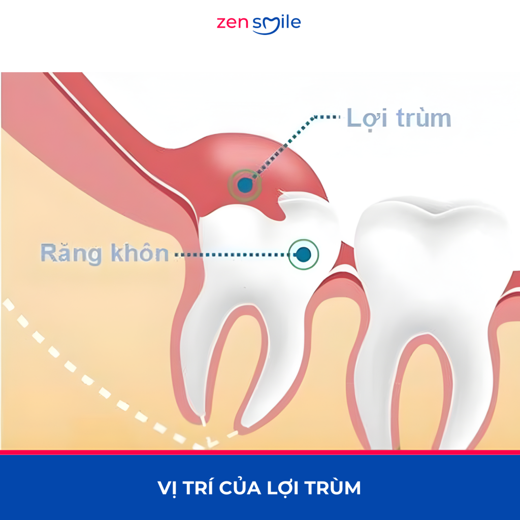 Rạch lợi trùm — ảnh 1