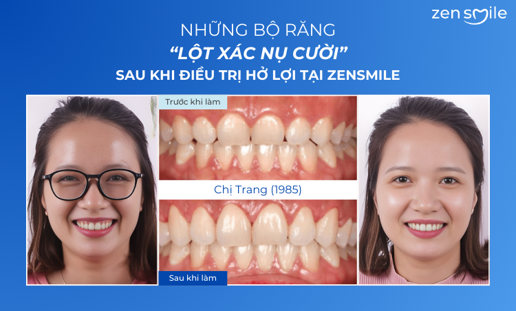 Ca trước – sau tại Nha khoa Zensmile 3