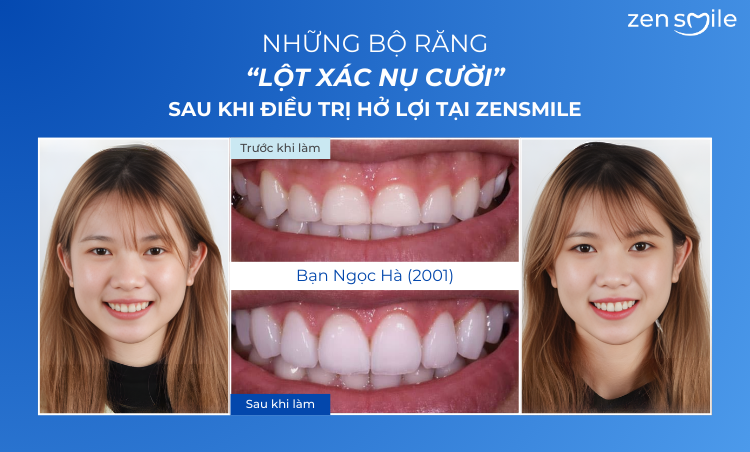 Ca trước – sau tại Nha khoa Zensmile 2