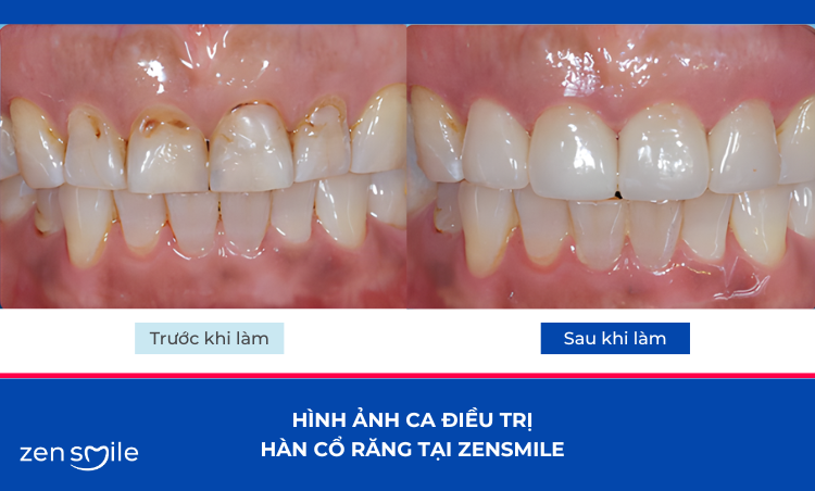 Hàn cổ răng — ảnh 5