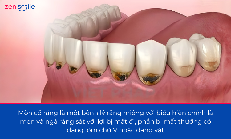 Hàn cổ răng — ảnh 2