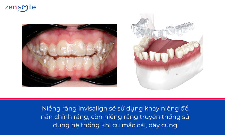 Invisalign Comprehensive mức 5 — ảnh 7