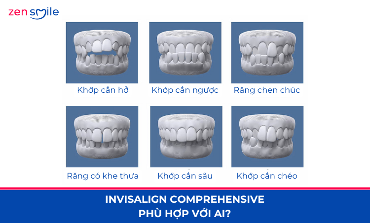 Invisalign Comprehensive mức 6 — ảnh 4