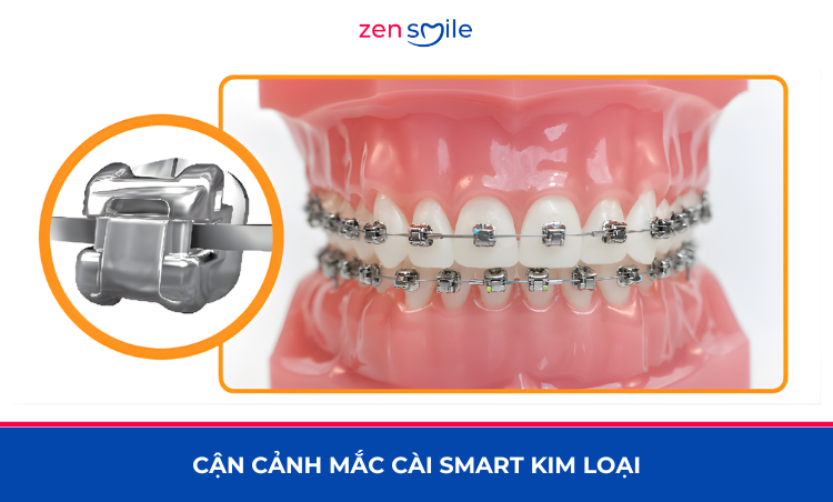 Mắc cài Smart kim loại — ảnh 3