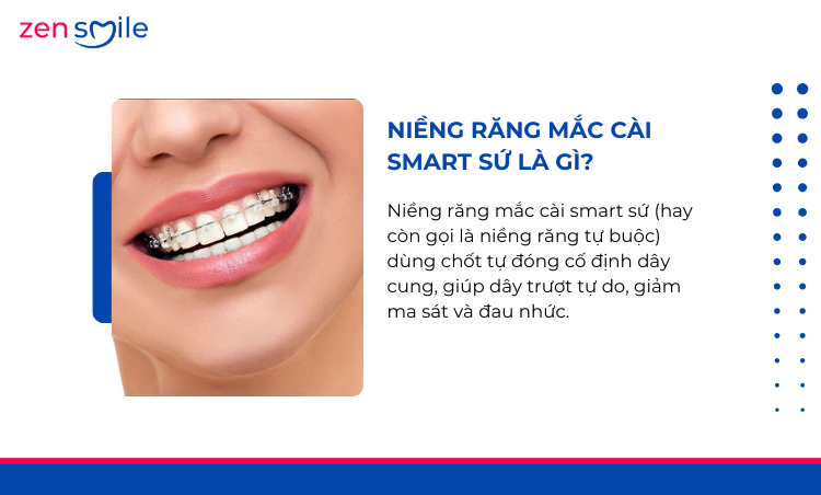 Mắc cài Smart sứ — ảnh 2