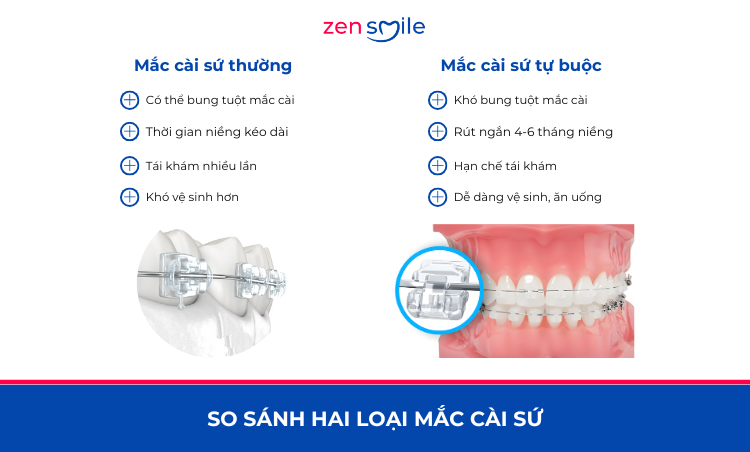Mắc cài Smart sứ — ảnh 7