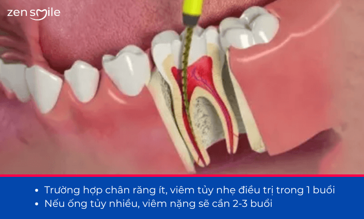 Điều trị tuỷ 1 lần hẹn (1 buổi) — ảnh 3