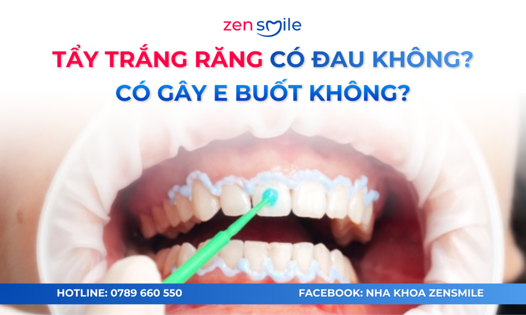 Tẩy trắng răng Nhật Bản — ảnh 2