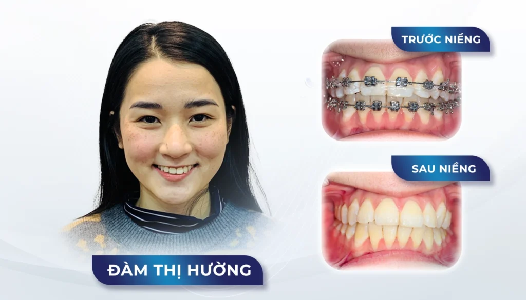 Mắc cài sứ truyền thống — ảnh 5