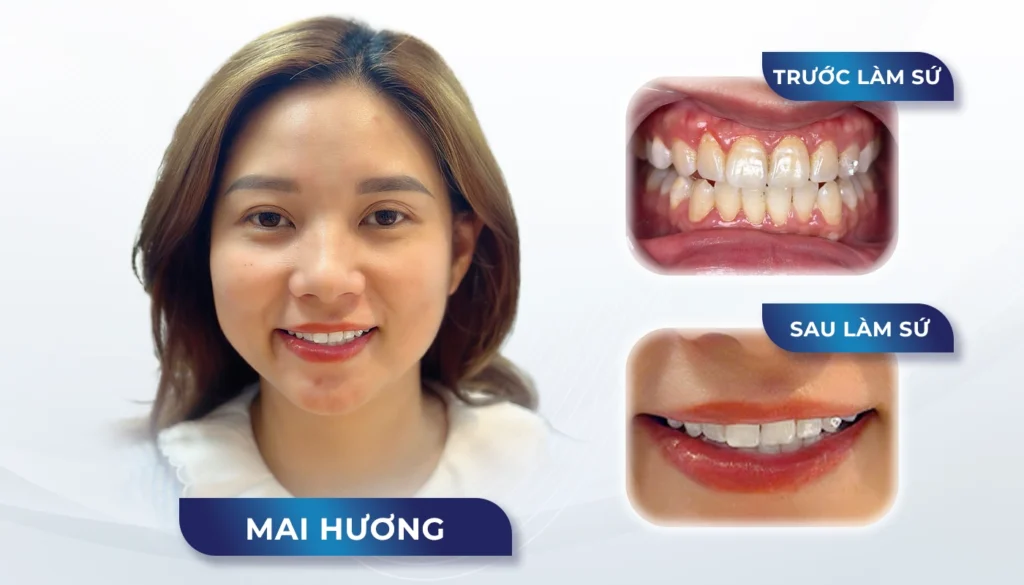 Răng sứ Venus — ảnh 7