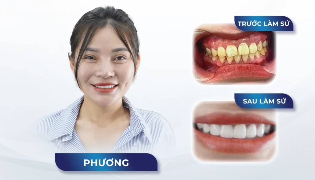 Răng sứ Ceramill — ảnh 7