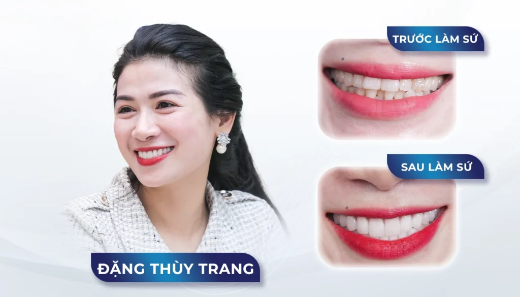 Răng sứ Katana — ảnh 7