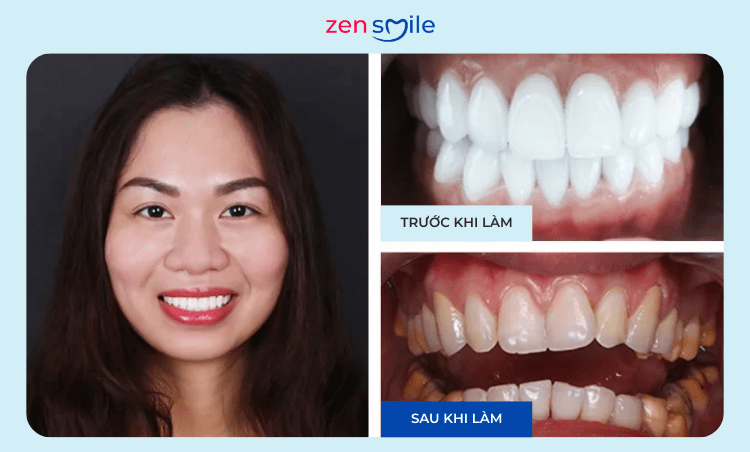 Răng sứ Ceramill — ảnh 6