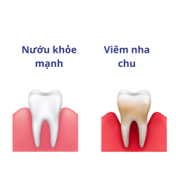 Điều trị nha chu không lật vạt