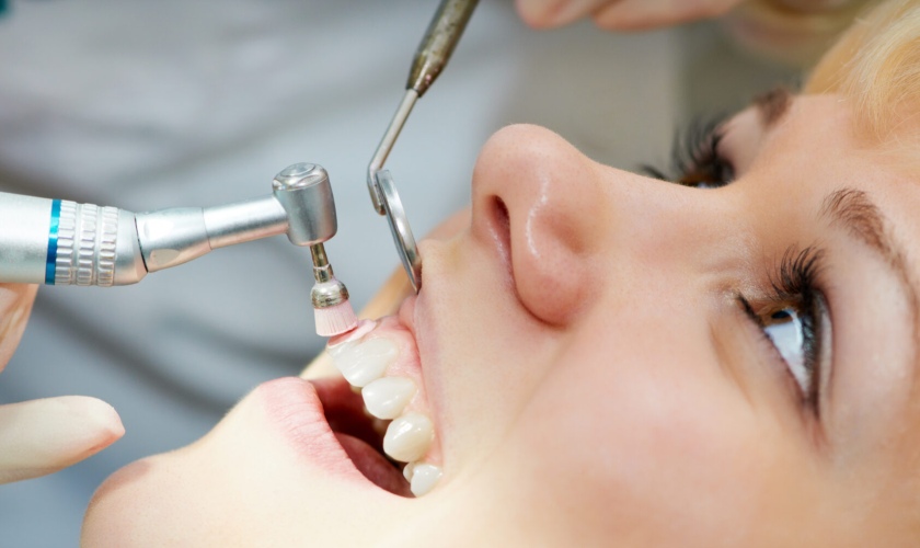 Đánh bóng răng — ảnh 3
