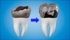 Chụp thép bảo vệ răng sữa trẻ em
