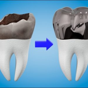Chụp thép bảo vệ răng sữa trẻ em