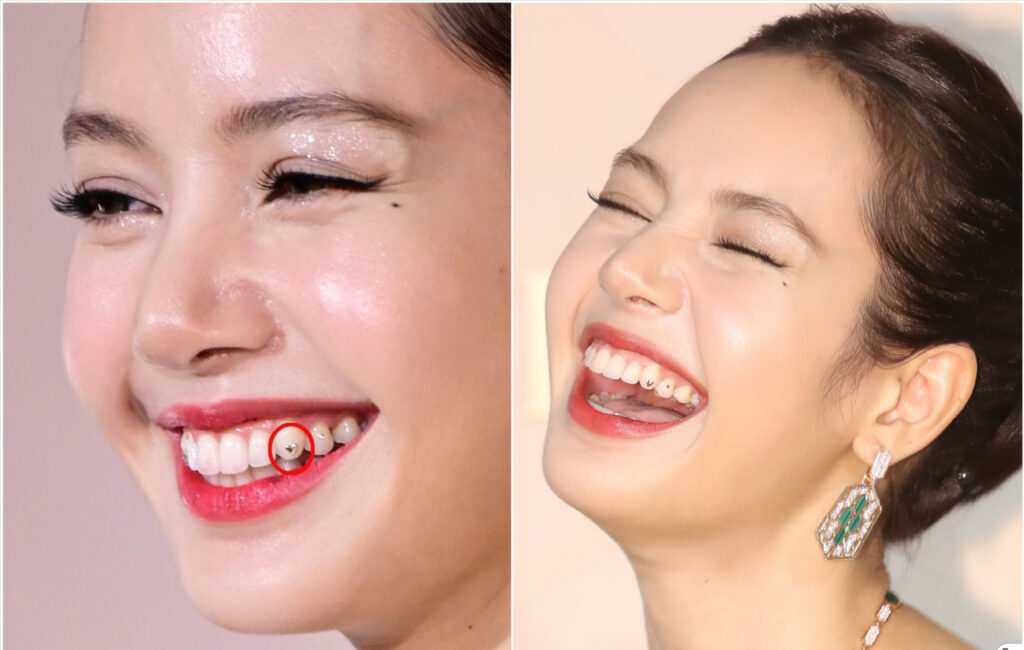 Đính đá nha khoa — ảnh 4
