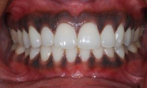 Điều trị nhiễm sắc tố lợi mức 1-3