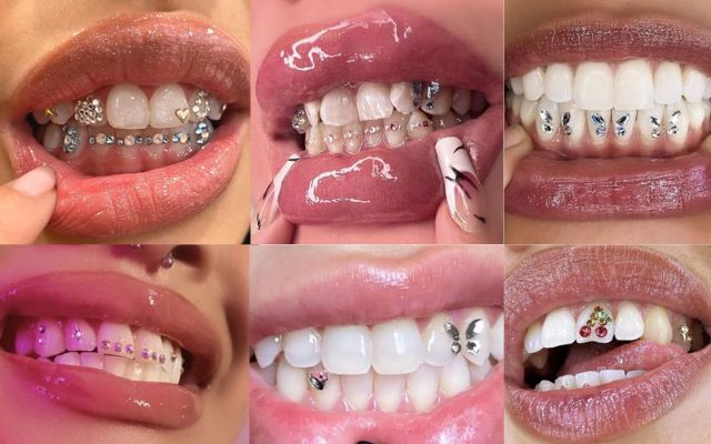 Đính đá nha khoa — ảnh 5