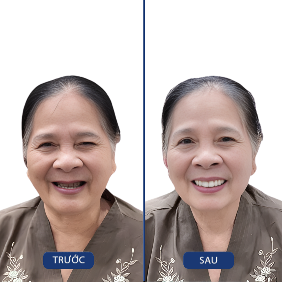 Trước và sau Trồng implant — khách hàng Nha khoa Zensmile