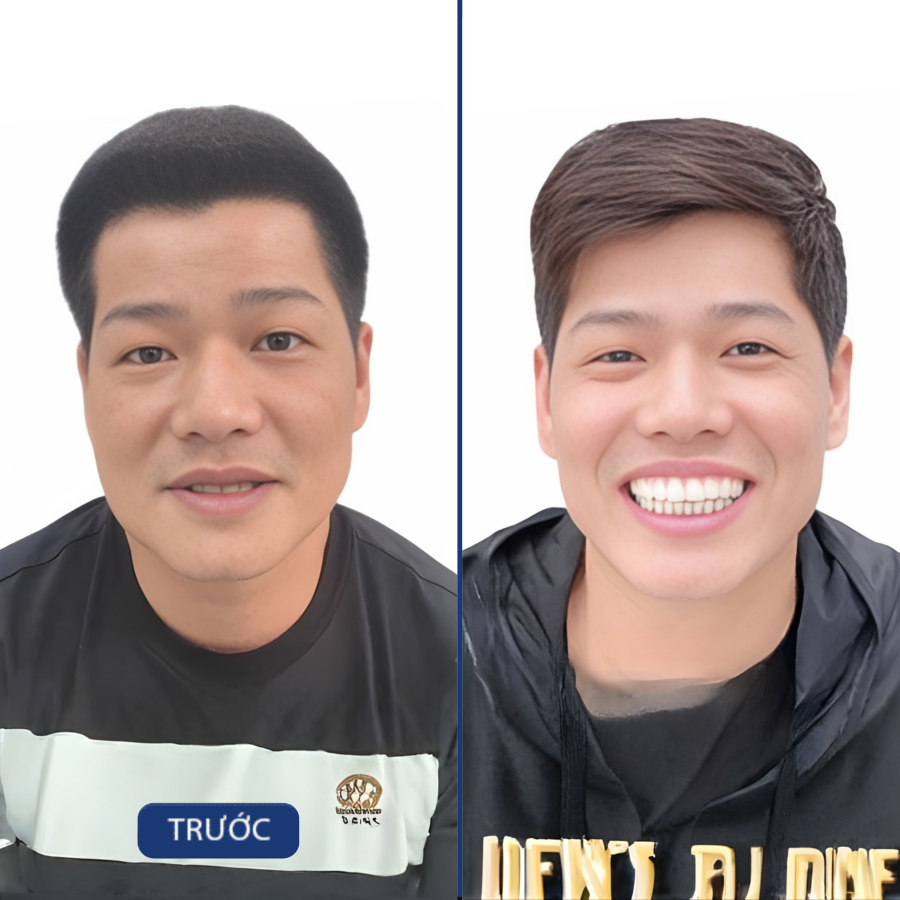 Trước và sau Trồng implant — khách hàng Nha khoa Zensmile