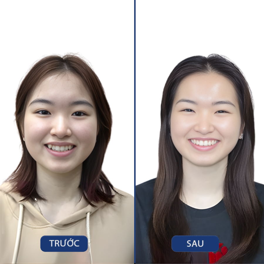 Trước và sau Niềng răng — khách hàng Nha khoa Zensmile
