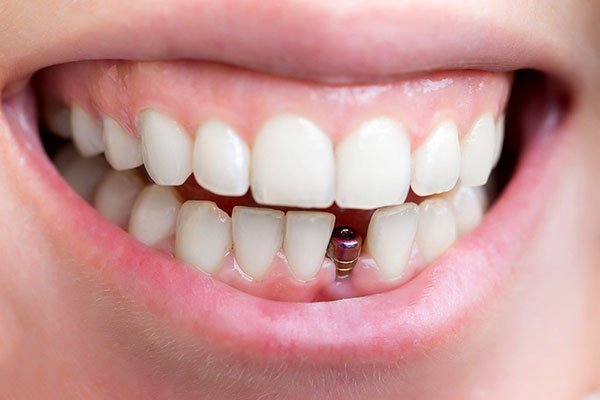 Trồng răng Implant