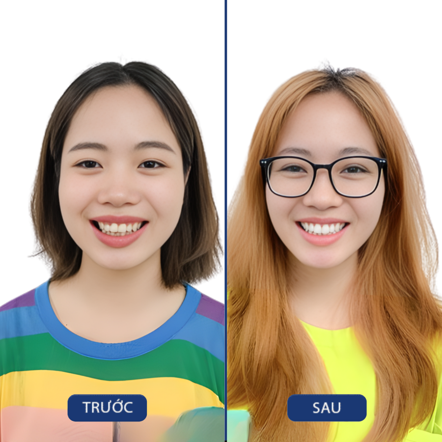 Trước và sau Răng sứ — khách hàng Nha khoa Zensmile
