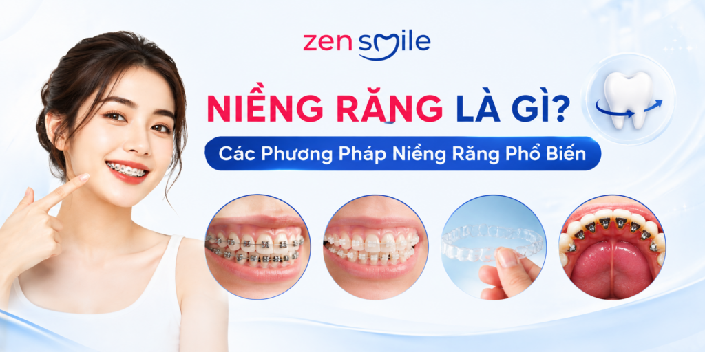 Niềng Răng Là Gì? Các Phương Pháp Niềng Răng Phổ Biến