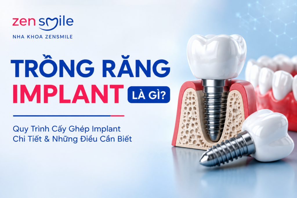 Trồng Răng Implant Là Gì? Quy Trình Cấy Ghép Implant