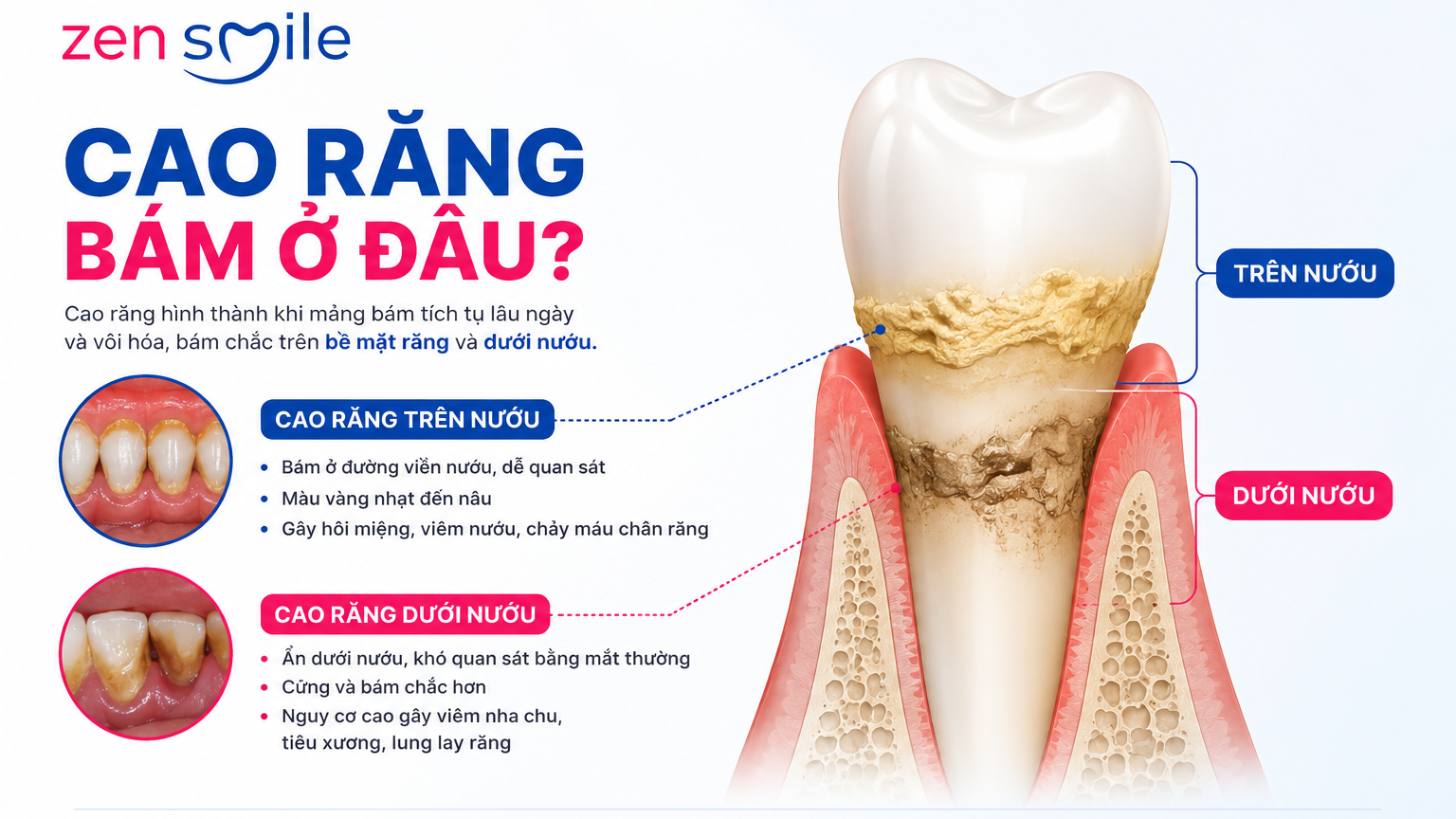 Cao răng và vôi răng tích tụ quanh đường viền nướu