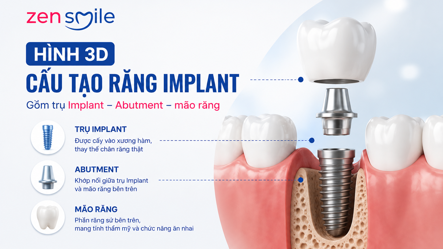 Cấu tạo trồng răng Implant gồm trụ Implant Abutment và mão răng.