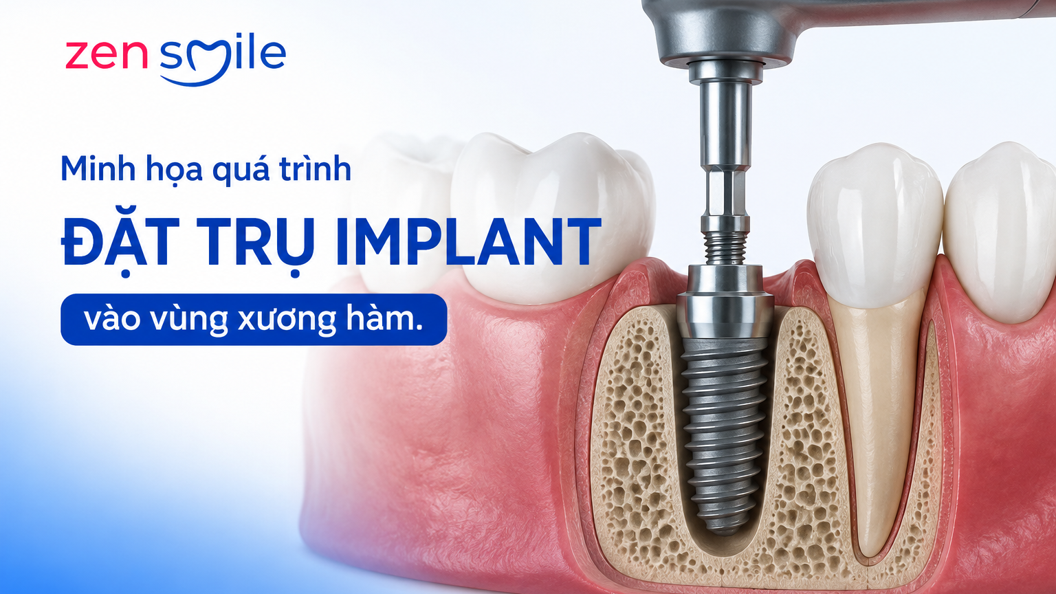 Quy trình đặt trụ trong trồng răng Implant.