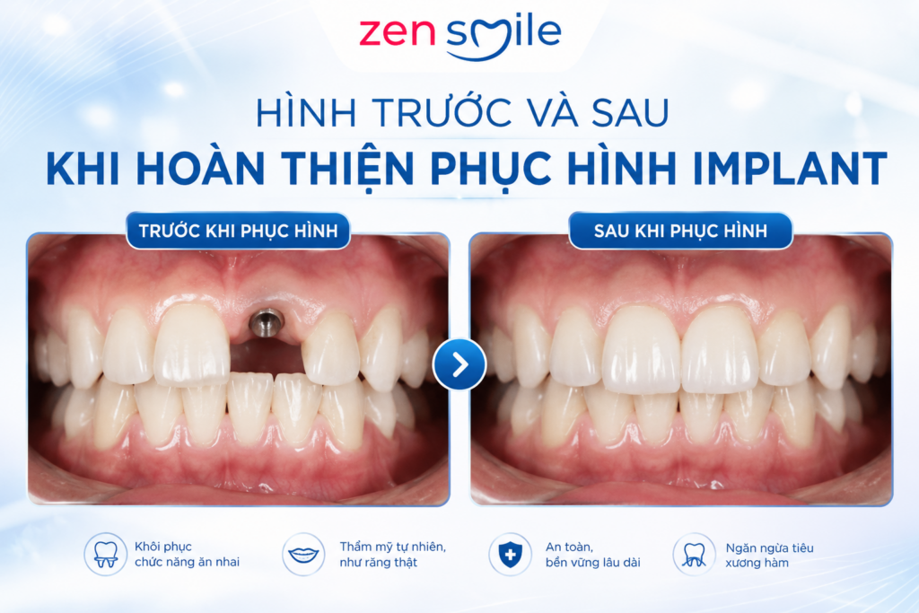 Kết quả phục hình sau khi trồng răng Implant.