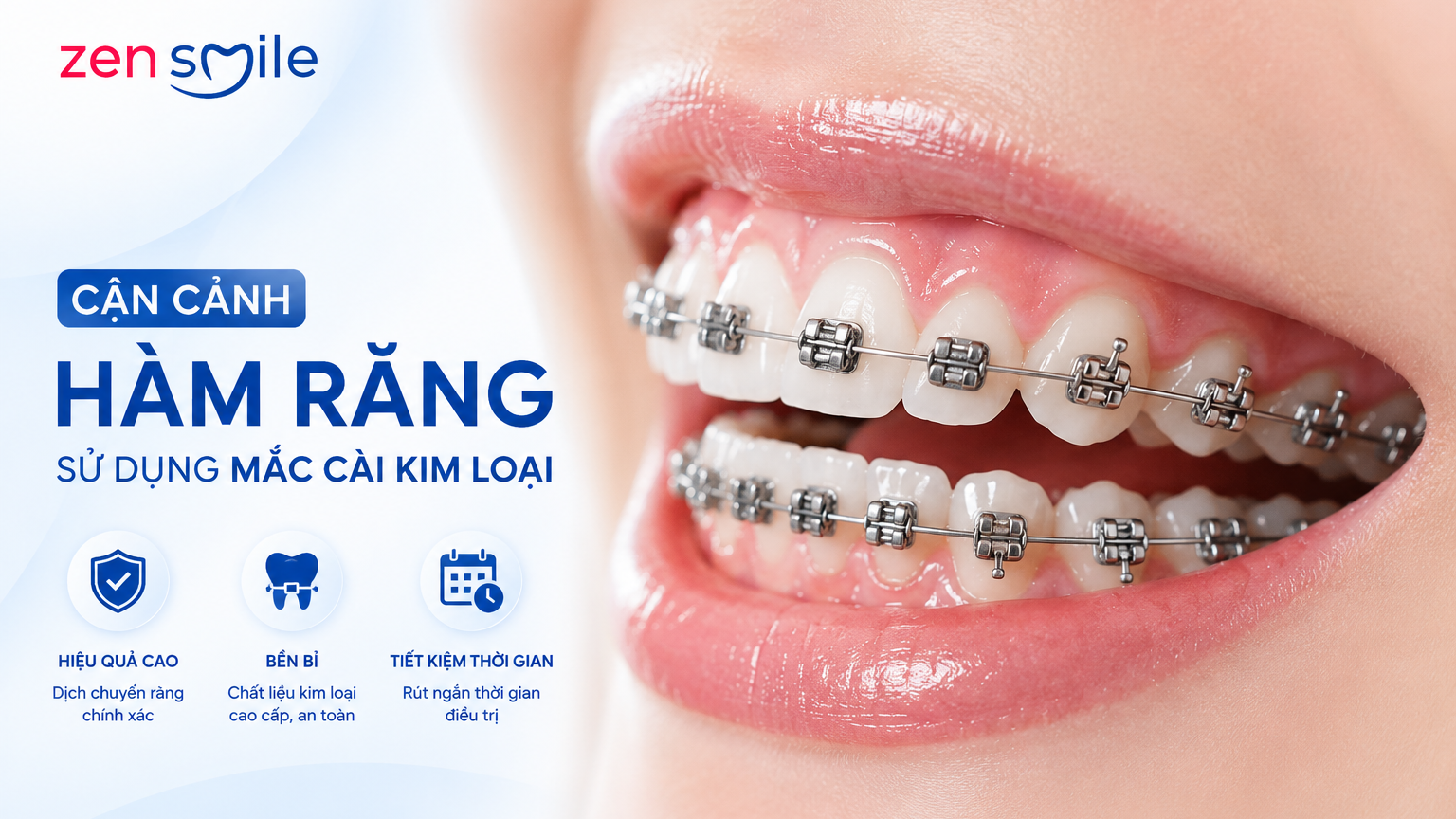 Phương pháp niềng răng mắc cài kim loại