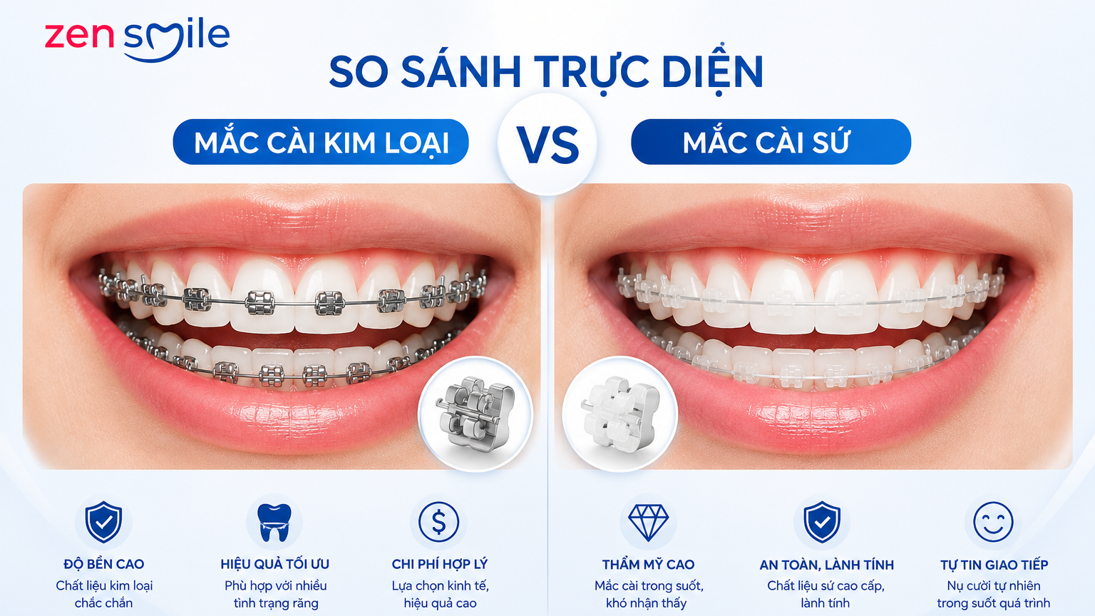 So sánh niềng răng mắc cài kim loại và mắc cài sứ